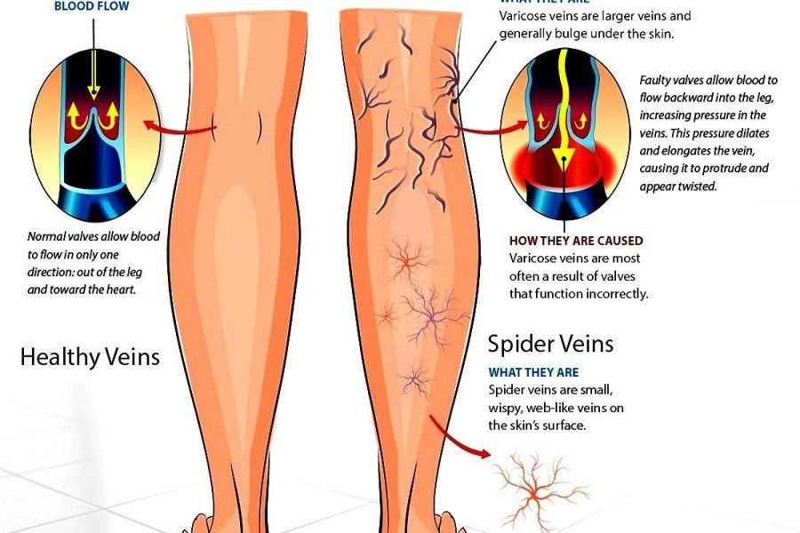 diosmin can improve vessel extension diosmin can improve vessel extension